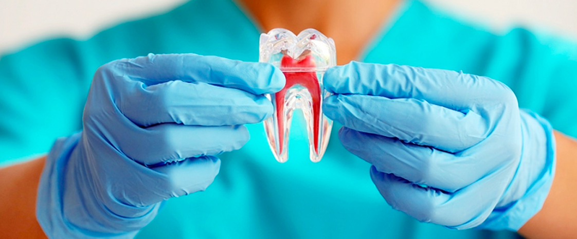 Endodontia - mulher segurando dente de amostra